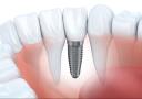 Dental Implants Near Me logo